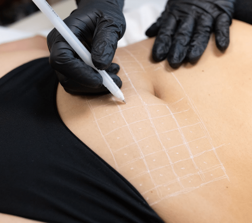 Fat Dissolving Injections: Procedure, Pain & After Care - MovMore Clinic