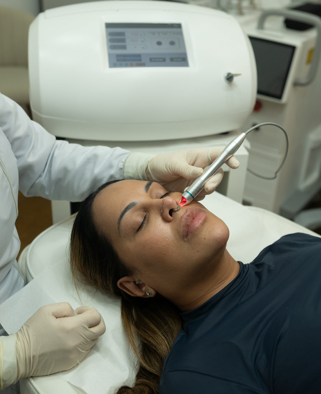 Laser Thread Vein Removal - Mov More Clinic