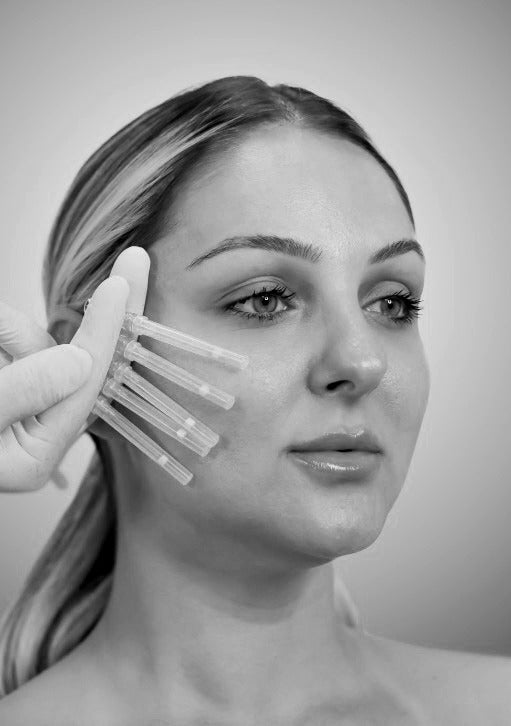 PRP Skin Treatment - Vampire Facial (Consultation Fee) - Mov More Clinic