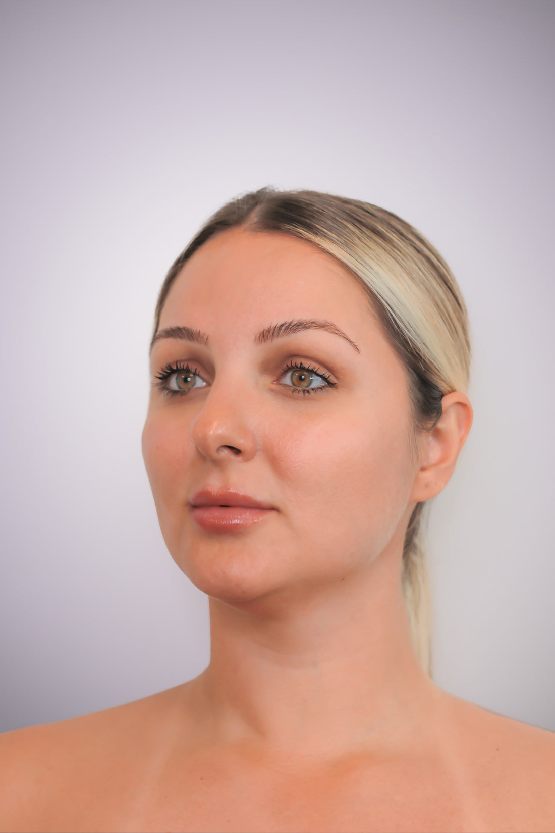 Fractional Laser Resurfacing with Fotona - Mov More Clinic