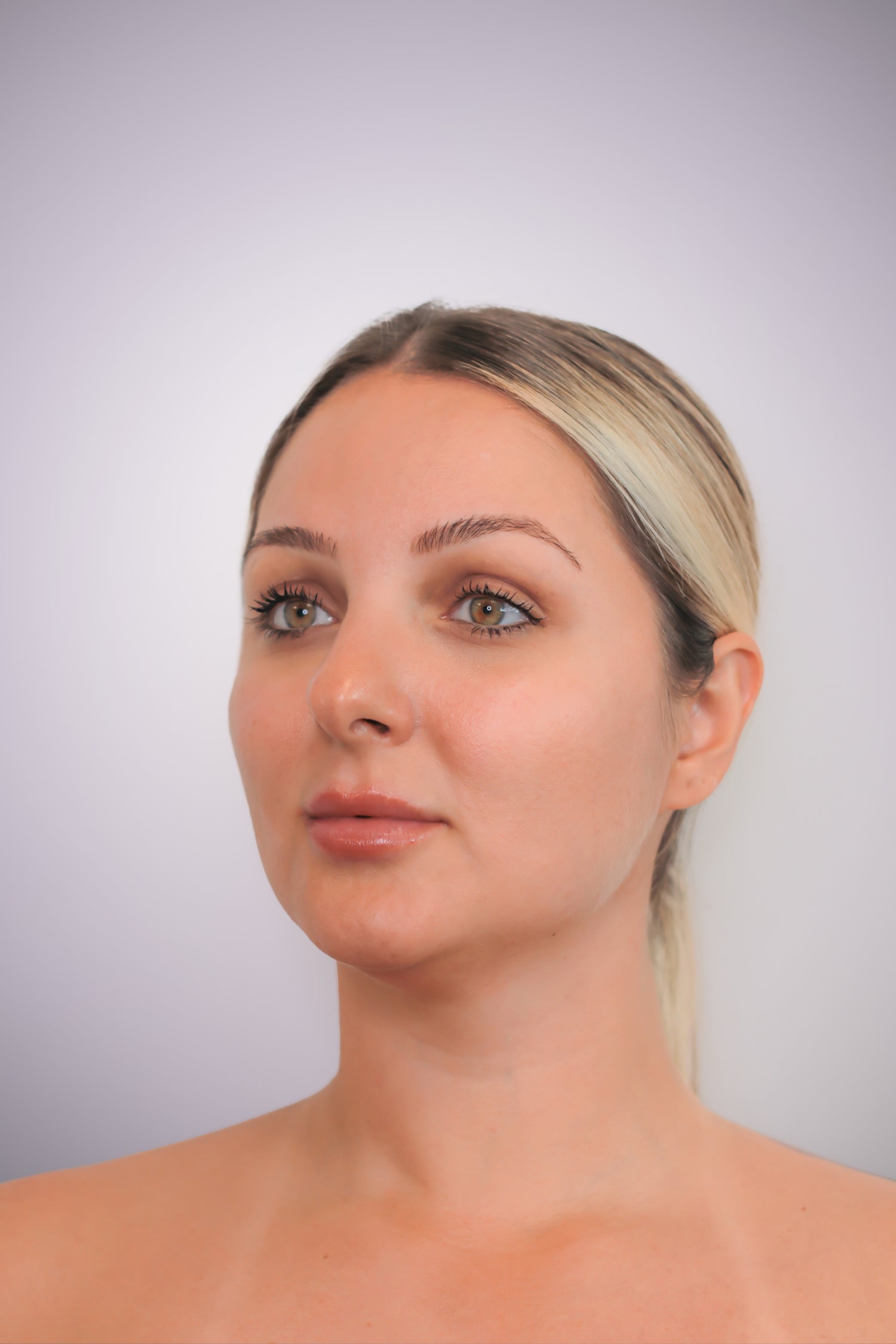 Fractional Laser Resurfacing with Fotona - Mov More Clinic