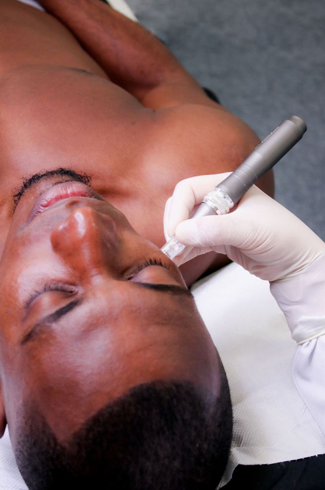 Microneedling - Mov More Clinic