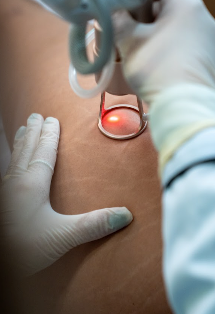Laser Fotona Intimate Rejuvenation
