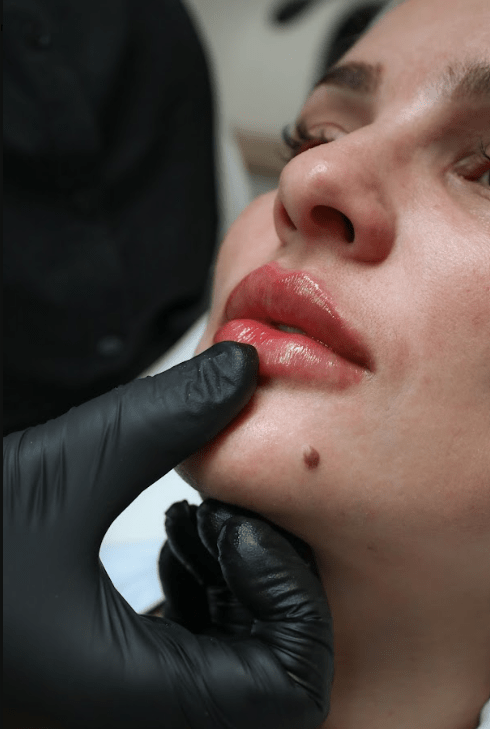 Bacio Italiano Lip Booster - MovMore Clinic