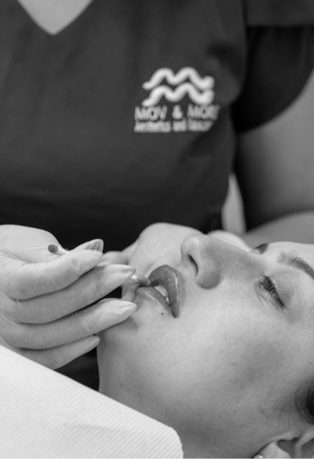 Laser Fotona Lips - LipLase Dublin