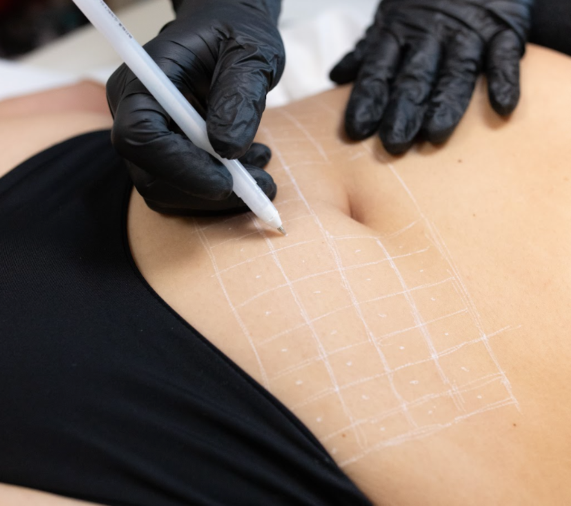 Fat Dissolving Injections: Procedure, Pain & After Care