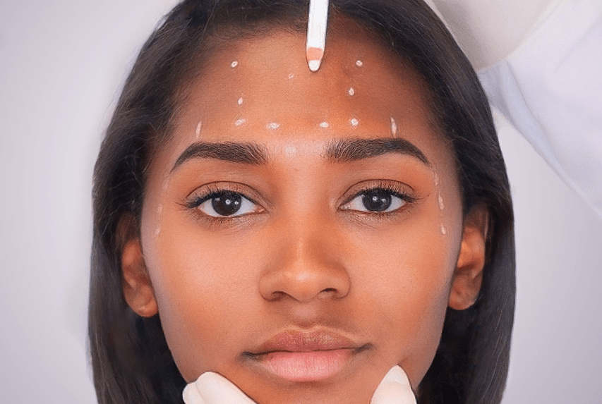 Injection Marking Anti-Wrinkle Treatment: Marking the Injection Sites – MovMore Clinic
