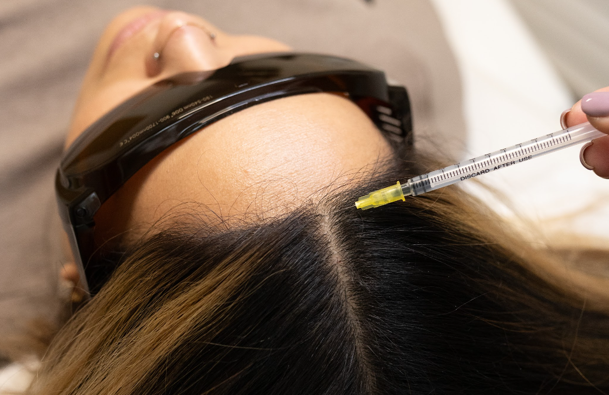 Hair Mesotherapy: Everything You Need to Know