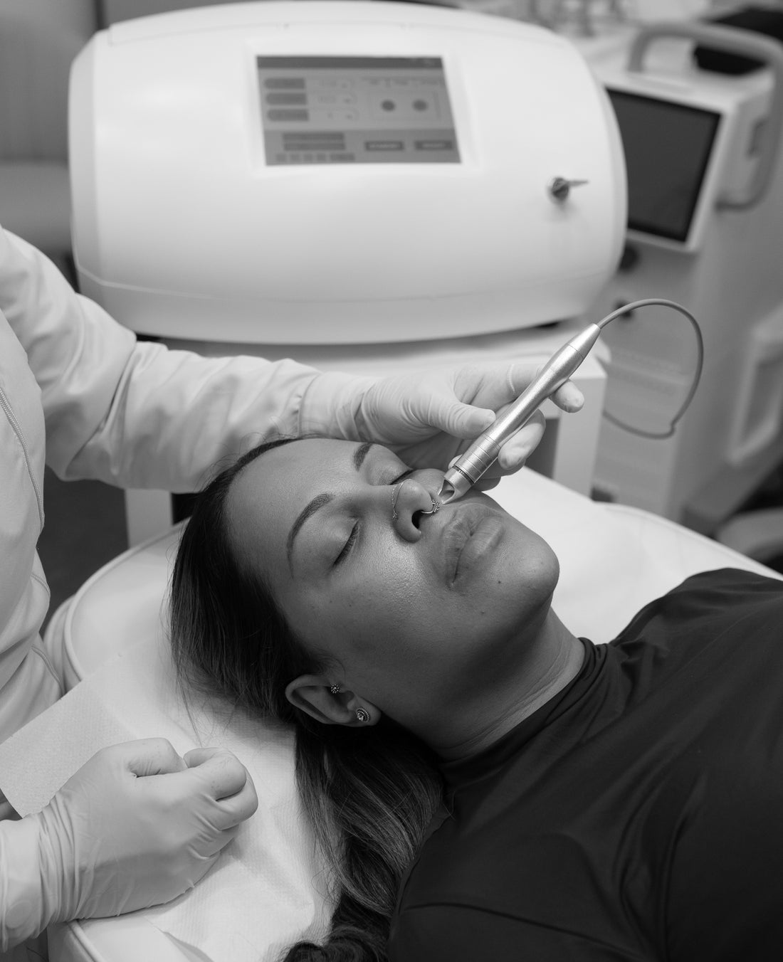 Laser Thread Vein Removal - Mov More Clinic