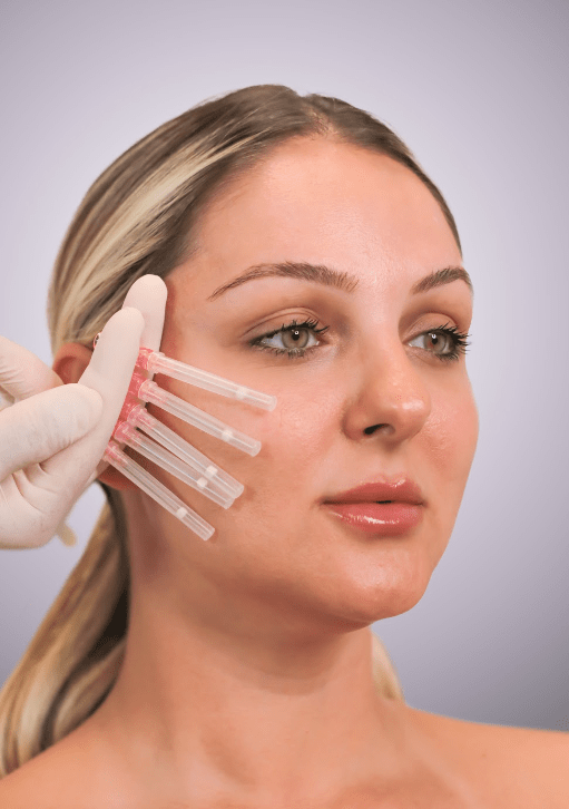 PRP Skin Treatment - Vampire Facial (Consultation Fee) - Mov More Clinic