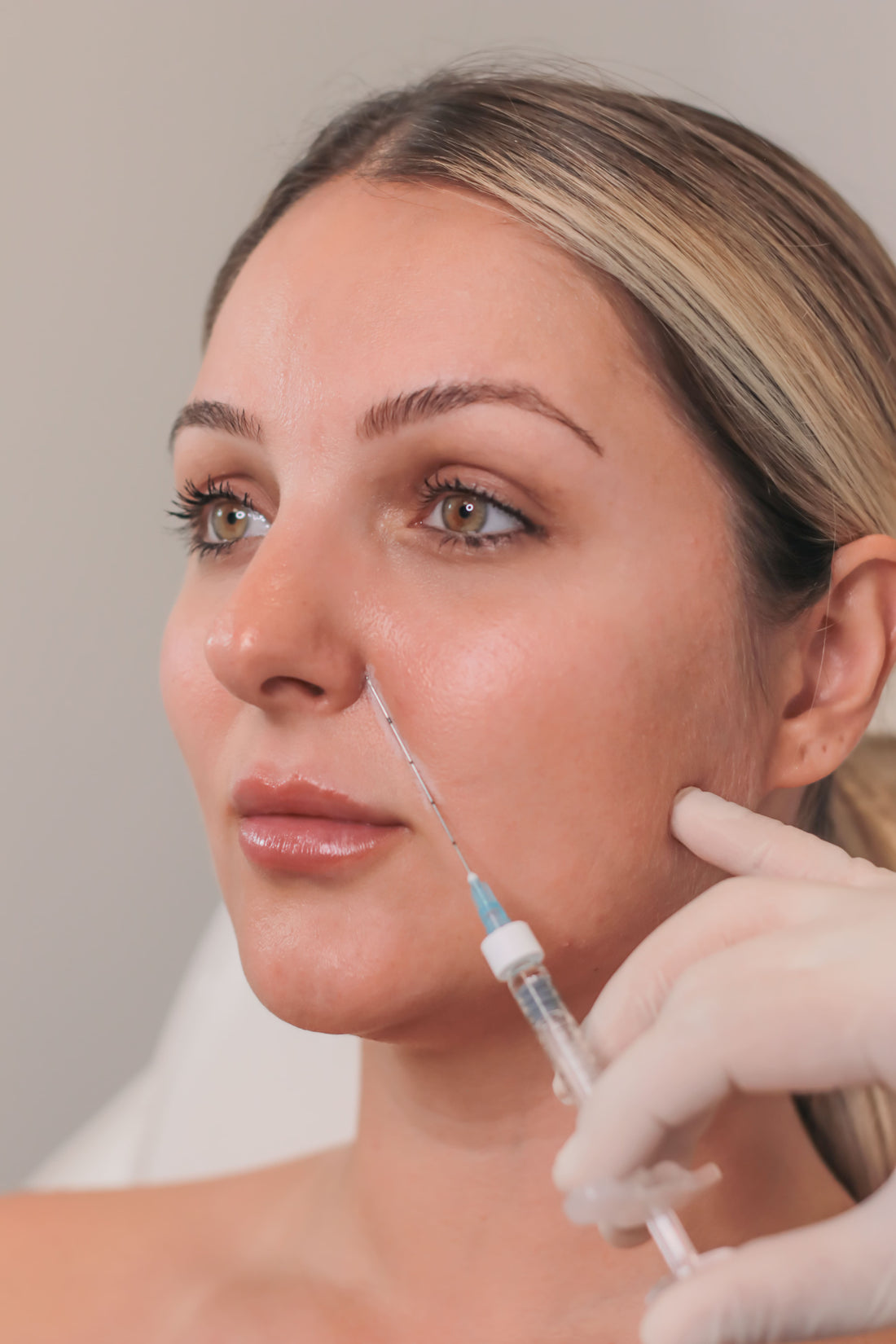 Nasolabial Folds Filler - Mov More Clinic