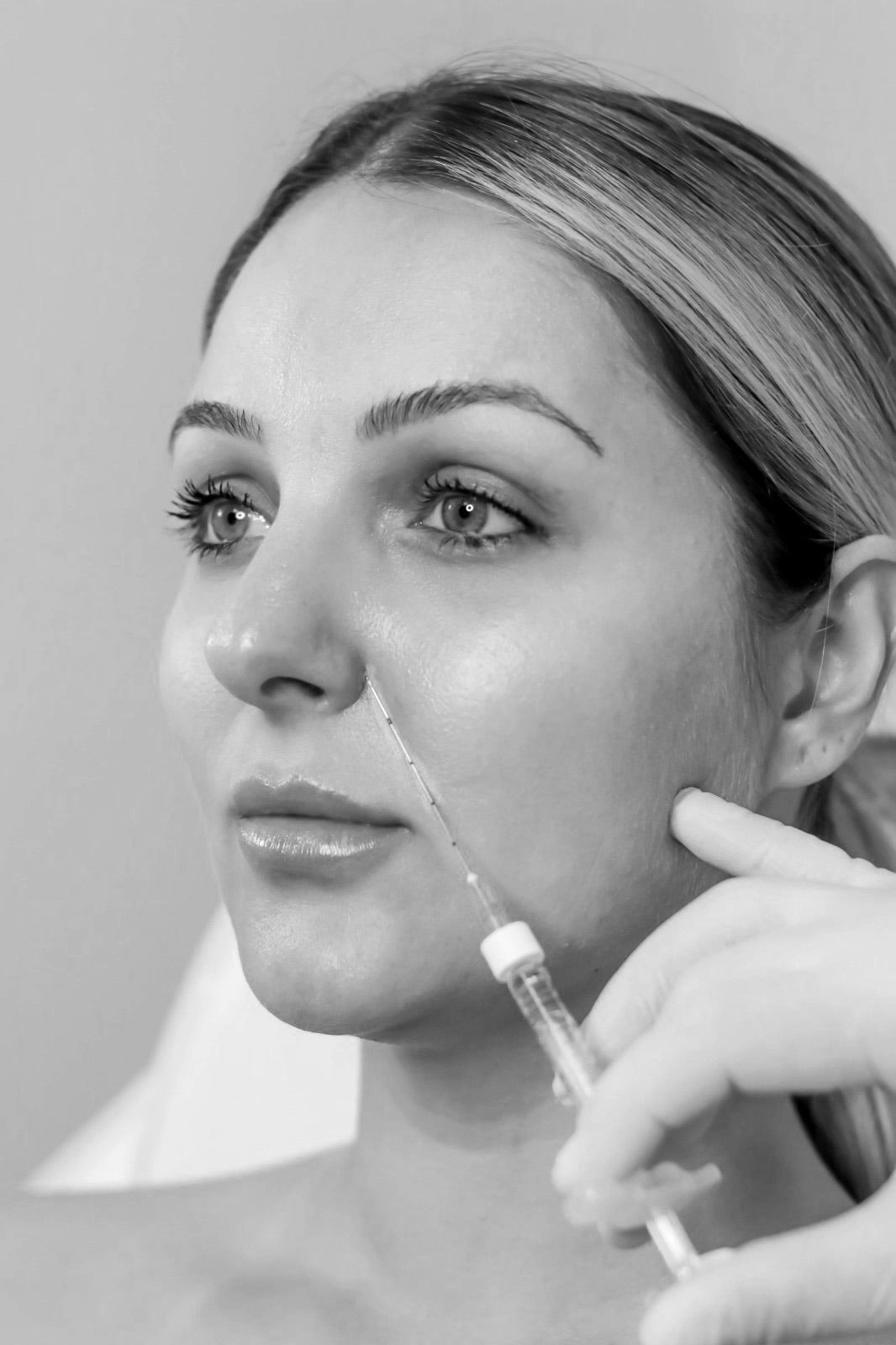 Nasolabial Folds Filler - Mov More Clinic