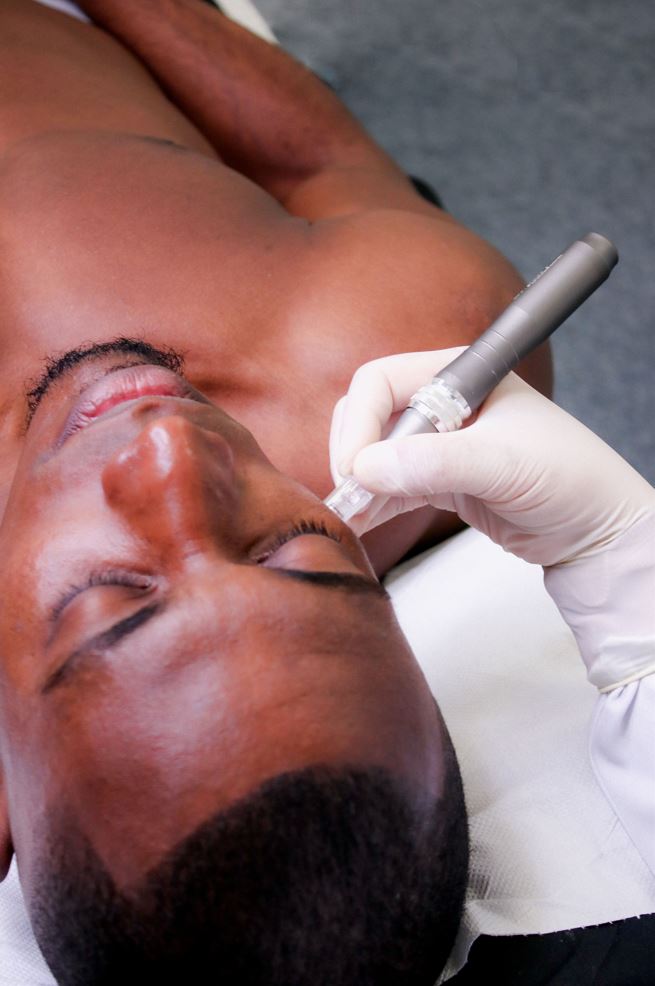 Microneedling