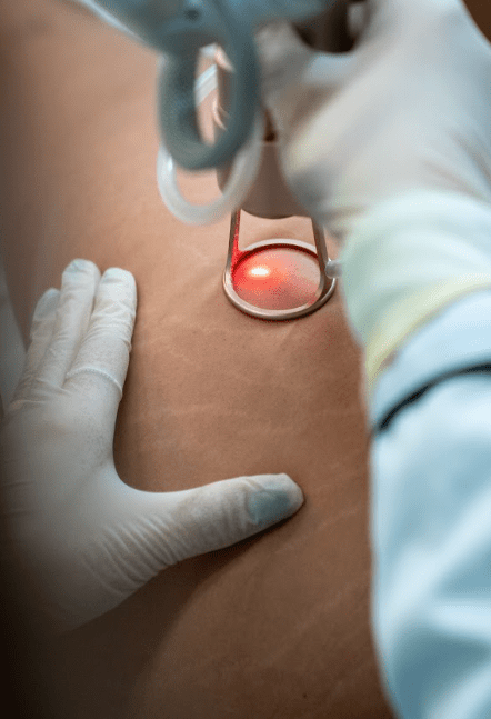 Laser Fotona Intimate Rejuvenation - MovMore Clinic