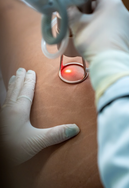 Laser Fotona Intimate Rejuvenation