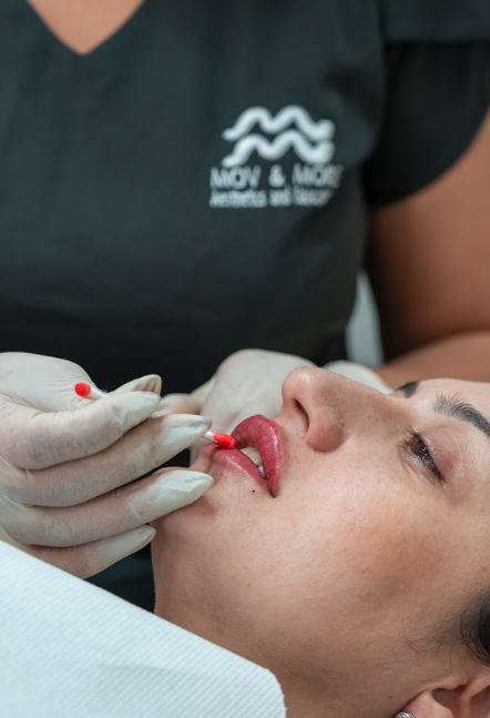 Laser Fotona Lips - LipLase Dublin